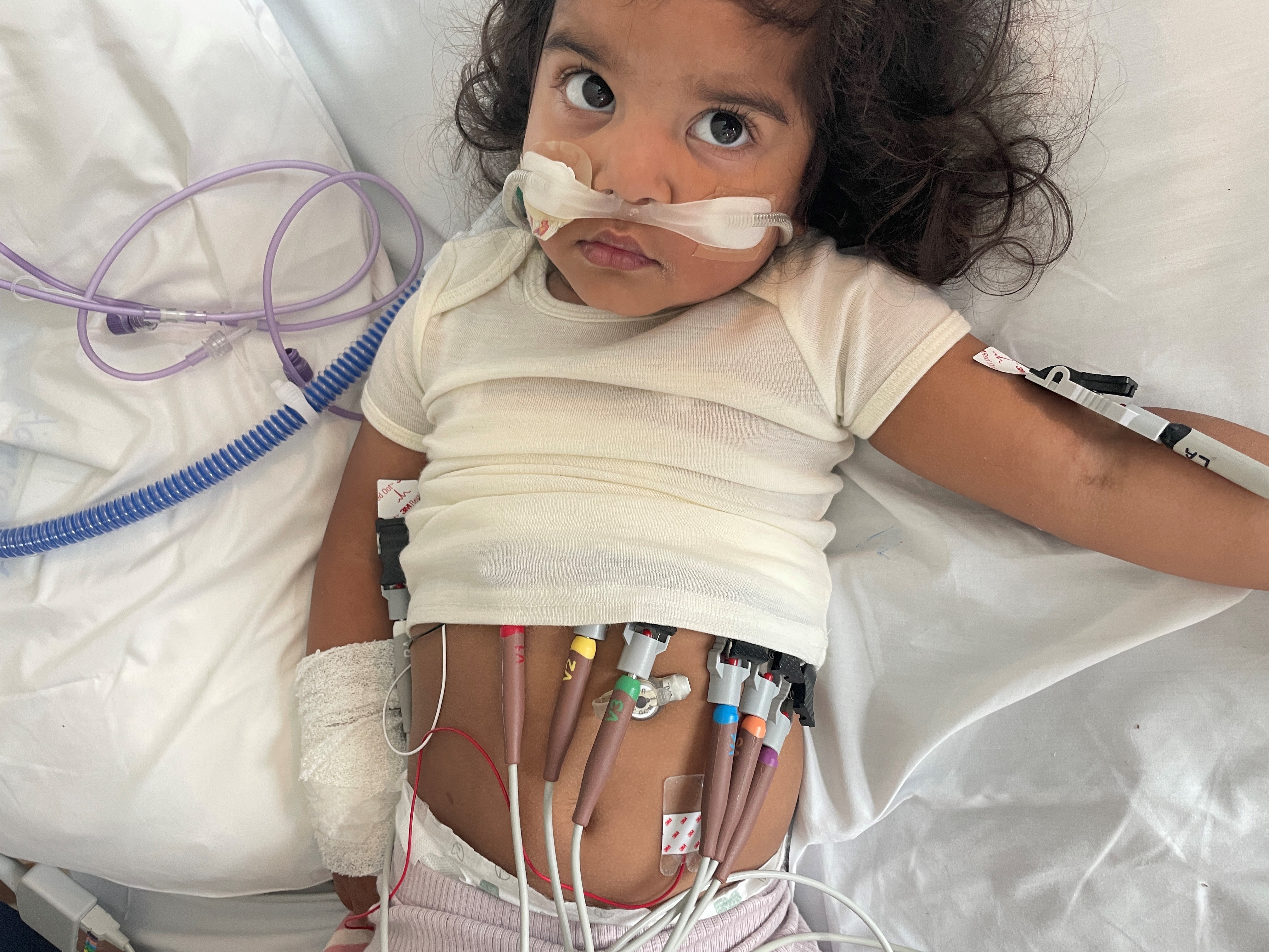 Four year old Zara, in hospital bed, with a nasogastric tube and multiple ports and tubes in her tummy.